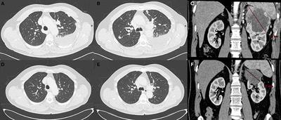 Vitiligo Adverse Event Observed in a Patient With Durable Complete Response After Nivolumab for Metastatic Renal Cell Carcinoma